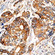 Immunohistochemistry analysis of paraffin-embedded Human colon carcinoma tissue using PI3 Kinase p85 alpha Rabbit pAb (STJ113725) at a dilution of 1:200 (40x lens). High pressure antigen retrieval performed with 0. 01M Citrate Bufferr (pH 6. 0) prior to immunohistochemistry staining.