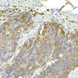 Immunohistochemistry analysis of paraffin-embedded human esophageal cancer using IFIH1 Rabbit polyclonal antibody (STJ115604) at dilution of 1:50 (40x lens). Perform high pressure antigen retrieval with 10 mM citrate buffer pH 6. 0 before commencing with immunohistochemistry staining protocol.