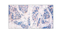 Immunohistochemistry breast cancer with Anti-BST2 Antibody (STJ500288) at NA dilution in NA.