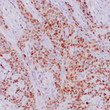 Anti-p21WAF1 antibody IHC Human colon adenocarcinoma STJ180533