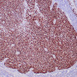 Anti-p40 antibody IHC human lung squamous cell carcinoma STJ180534