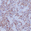 Anti-Thymidylate Synthase antibody IHC Human urothelial carcinoma STJ180544
