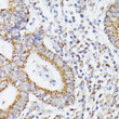 Immunohistochemistry analysis of RHOG in paraffin-embedded human colon carcinoma using RHOG Rabbit polyclonal antibody (STJ11103021) at dilution of 1:100 (40x lens). Perform microwave antigen retrieval with 10 mM PBS buffer pH 7. 2 before commencing with immunohistochemistry staining protocol.