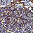 Immunohistochemistry analysis of paraffin-embedded Human anaplastic large cell lymphoma using Human IgM Rabbit monoclonal antibody (STJ11103092) at dilution of 1:100 (40x lens). Perform high pressure antigen retrieval with 10 mM citrate buffer pH 6. 0 before commencing with immunohistochemistry staining protocol.