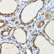 Immunohistochemistry analysis of FAM117A in paraffin-embedded human thyroid cancer using FAM117A Rabbit polyclonal antibody (STJ11103174) at dilution of 1:100 (40x lens). Perform high pressure antigen retrieval with 10 mM citrate buffer pH 6. 0 before commencing with immunohistochemistry staining protocol.