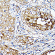Immunohistochemistry analysis of LLGL1 in paraffin-embedded human breast cancer using LLGL1 Rabbit polyclonal antibody (STJ11103225) at dilution of 1:50 (40x lens). Perform high pressure antigen retrieval with 10 mM citrate buffer pH 6. 0 before commencing with immunohistochemistry staining protocol.