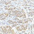 Immunohistochemistry analysis of FAM3A in paraffin-embedded human esophageal cancer using FAM3A Rabbit polyclonal antibody (STJ11103413) at dilution of 1:50 (40x lens). Perform high pressure antigen retrieval with 10 mM citrate buffer pH 6. 0 before commencing with immunohistochemistry staining protocol.