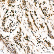 Immunohistochemistry analysis of paraffin-embedded Human breast cancer tissue using FUBP1 Rabbit mAb  (STJ11103646) at a dilution of 1:200 (40x lens).  High pressure antigen retrieval was performed with 0. 01 M citrate buffer (pH 6. 0) prior to immunohistochemistry staining.