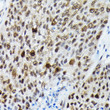 Immunohistochemistry analysis of paraffin-embedded Human lung cancer using Phospho-FOXO3A-S425 Rabbit pAb (STJ11103738) at dilution of 1:200 (40x lens). High pressure antigen retrieval performed with 0. 01M Citrate Bufferr (pH 6. 0) prior to immunohistochemistry staining.