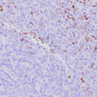 Anti-MSH-6 antibody IHC human colon carcinoma STJ180582