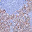 Anti-ROS1 antibody IHC human node with metastatic lung STJ180593