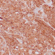 Anti-VEGF antibody IHC human breast carcinoma STJ180601