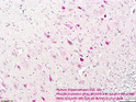 IHC staining human hippocampus-CA1 neurons tau phosphorylation at Ser 416 using antibody STJA0003796