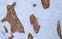 Human esophageal squamous cell carcinoma tissue was stained with Anti-GST-Pi (ABT256) Antibody