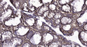 Immunohistochemical analysis of paraffin-embedded human colon cancer. 1, Tris-EDTA, pH9.0 was used for antigen retrieval. 2 Antibody was diluted at 1:200 (4°C overnight. 3, Secondary antibody was diluted at 1:200 (room temperature, 45min).