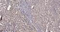 Immunohistochemical analysis of paraffin-embedded human liver cancer. 1, Antibody was diluted at 1:200 (4°C overnight). 2, Tris-EDTA, pH9.0 was used for antigen retrieval. 3, Secondary antibody was diluted at 1:200 (room temperature, 45min).