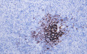 Human diffuse large B-cell lymphoma tissue was stained with Anti-CD23 (ABT-CD23) Antibody