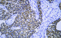 Human Breast Cancer tissue was stained with Anti-Cytokeratin 8 (ABT534) Antibody