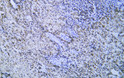 Human hepatocellular carcinomatissue was stained with Anti-Cytokeratin 8 (ABT534) Antibody