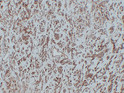 Human Hemangioendothelioma tissue was stained with Anti-CD31 (ABT-CD31) Antibody