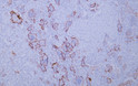 Human giant cell tumor tissue was stained with Anti-CD61 (ABT032) Antibody