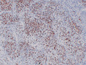 Immunohistochemical analysis of paraffin-embedded Rhabdomyosarcoma. 1, Antibody was diluted at 1:200 (4°C overnight). 2, Citric acid, pH6.0 was used for antigen retrieval. 3, Secondary antibody was diluted at 1:200 (room temperature, 30min).