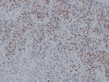 Immunohistochemical analysis of paraffin-embedded Rhabdomyosarcoma. 1, Antibody was diluted at 1:200 (4°C overnight). 2, Citric acid, pH6.0 was used for antigen retrieval. 3, Secondary antibody was diluted at 1:200 (room temperature, 30min).