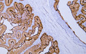 Immunohistochemistry - Paraffin (IHC-P): Human colon carcinoma tissue was stained with anti-Villin (PT0254) antibody. STJ196870