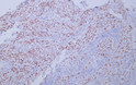 Human endometrial adenocarcinoma tissue was stained with Anti-Wilms' Tumor 1 (WT1) (ABT-WT1) Antibody