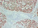 Immunohistochemical analysis of paraffin-embedded Pancreatic carcinoma. 1, Antibody was diluted at 1:200 (4°C overnight). 2, TRIS-EDTA of pH8.0 was used for antigen retrieval. 3, Secondary antibody was diluted at 1:200 (room temperature, 30min).