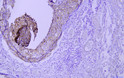 Immunohistochemical analysis of paraffin-embedded human mammary cancer Antibody was diluted at 1:200 (4°C overnight).