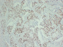 Immunohistochemistry - Paraffin (IHC-P): Human lung squamous cell carcinoma tissue was stained with Anti-p40 (ABT-P40) STJ196999