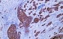 Human breast carcinoma tissue was stained with Anti-Her-2 (ABT338) Antibody Human breast carcinoma tissue was stained with Anti-Her-2 (ABT338) Antibody
