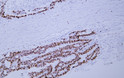Human colon carcinoma tissue was stained with Anti-Ki-67 (ABT001) Antibody