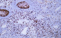 Human malignant melanoma tissue was stained with Anti-Ki-67 (ABT001) Antibody