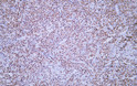 Human diffuse large B-cell lymphoma tissue was stained with Anti-Oct-2 (ABT211) Antibody