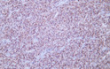 Human diffuse large B-cell lymphoma tissue was stained with Anti-CD20 (ABT065) Antibody