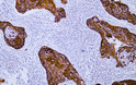 Human cervical squamous cell carcinoma tissue was stained with Anti-Cytokeratin 16 (ABT059) Antibody