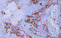 Human esophageal squamous cell carcinoma tissue was stained with Anti-Cytokeratin 16 (ABT059) Antibody