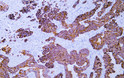 Human rectal carcinoma tissue was stained with Anti-Cytokeratin 20 (ABT044) Antibody