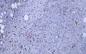 Human dermatofibrosarcoma protuberans tissue was stained with Anti-Factor XIIIa (ABT170) Antibody