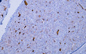 Human hepatocellular carcinoma tissue was stained with Anti-Glypican-3 (ABT068) Antibody