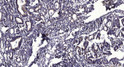 Immunohistochemical analysis of paraffin-embedded human Gastric adenocarcinoma. 1, Antibody was diluted at 1:200 (4°C overnight). 2, Tris-EDTA, pH9.0 was used for antigen retrieval. 3, Secondary antibody was diluted at 1:200 (room temperature, 45min).