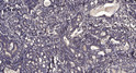 Immunohistochemical analysis of paraffin-embedded human Gastric adenocarcinoma. 1, Antibody was diluted at 1:200 (4°C overnight). 2, Tris-EDTA, pH9.0 was used for antigen retrieval. 3, Secondary antibody was diluted at 1:200 (room temperature, 45min).
