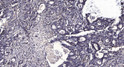 Immunohistochemical analysis of paraffin-embedded human Gastric adenocarcinoma. 1, Antibody was diluted at 1:200 (4°C overnight). 2, Tris-EDTA, pH9.0 was used for antigen retrieval. 3, Secondary antibody was diluted at 1:200 (room temperature, 45min).