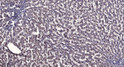 Immunohistochemical analysis of paraffin-embedded human liver cancer. 1, Antibody was diluted at 1:200 (4°C overnight). 2, Tris-EDTA, pH9.0 was used for antigen retrieval. 3, Secondary antibody was diluted at 1:200 (room temperature, 45min).