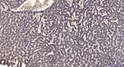 Immunohistochemical analysis of paraffin-embedded human liver cancer. 1, Antibody was diluted at 1:200 (4°C overnight). 2, Tris-EDTA, pH9.0 was used for antigen retrieval. 3, Secondary antibody was diluted at 1:200 (room temperature, 45min).