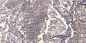 Immunohistochemical analysis of paraffin-embedded human Squamous cell carcinoma of lung. 1, Antibody was diluted at 1:200 (4°C overnight). 2, Tris-EDTA, pH9.0 was used for antigen retrieval. 3, Secondary antibody was diluted at 1:200 (room temperature, 45min).