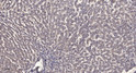 Immunohistochemical analysis of paraffin-embedded human liver cancer. 1, Antibody was diluted at 1:200 (4°C overnight). 2, Tris-EDTA, pH9.0 was used for antigen retrieval. 3, Secondary antibody was diluted at 1:200 (room temperature, 45min).