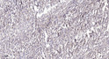 Immunohistochemical analysis of paraffin-embedded human Colon cancer. 1, Antibody was diluted at 1:200 (4°C overnight). 2, Tris-EDTA, pH9.0 was used for antigen retrieval. 3, Secondary antibody was diluted at 1:200 (room temperature, 45min).